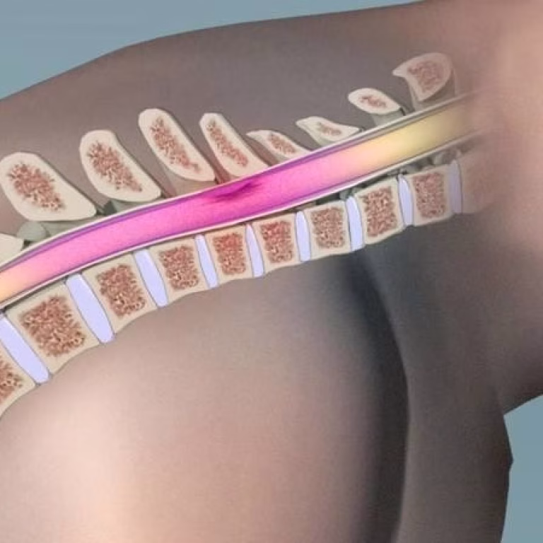 16x9_image-for-microsites_Bydon_stem-cells-for-paralysis_3863548-006-01